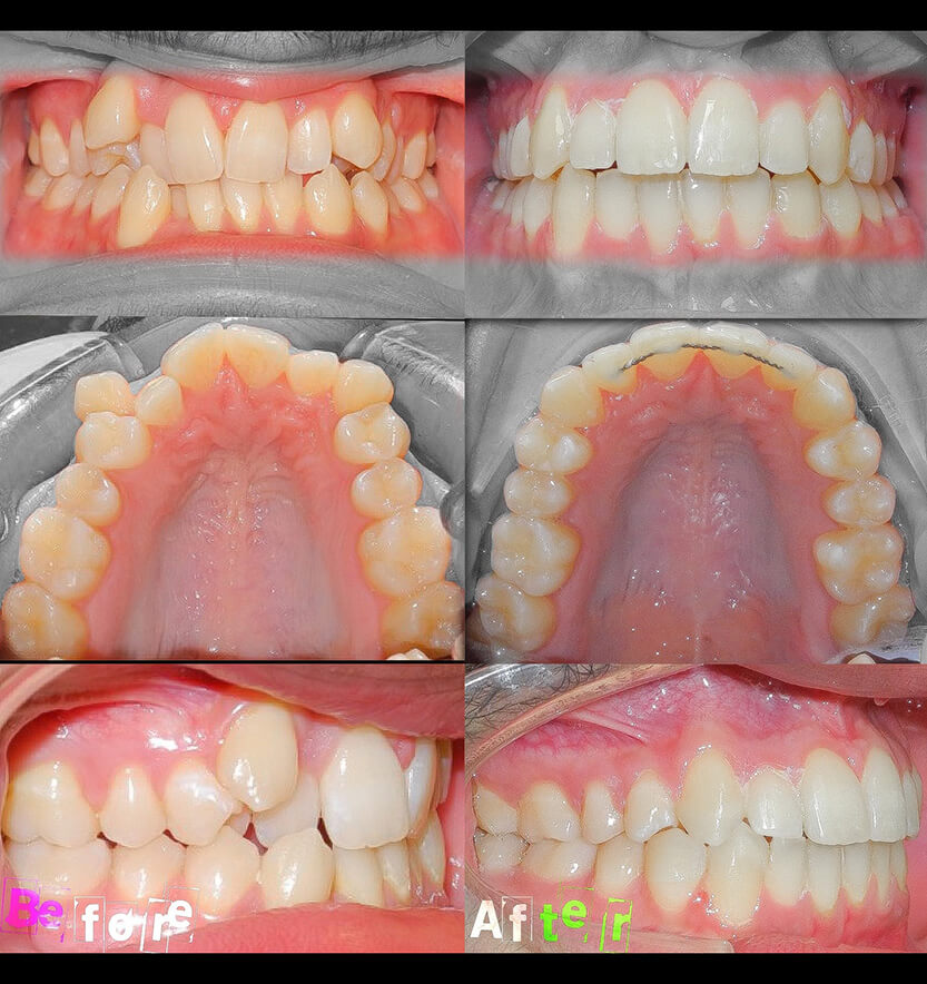 Front and side view of smile and inside of bottom teeth before and after crowding treatment