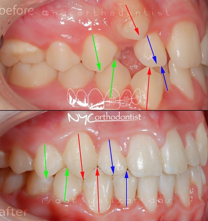 Closeup of side of smile before and after crowding treatment