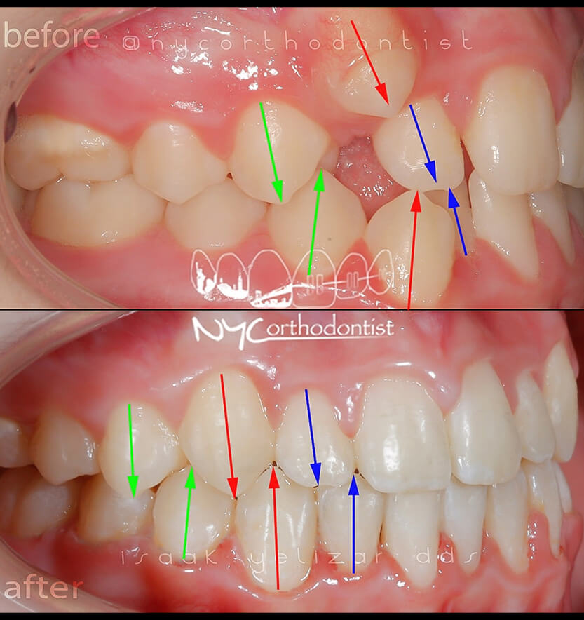 Closeup of side of smile before and after crowding treatment
