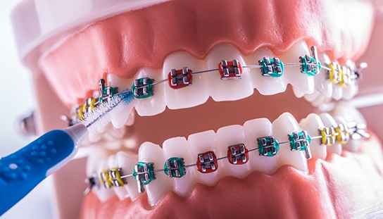 braces being flossed to prevent an emergency 
