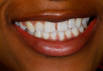 Closeup of smile anterior crossbite prior to treatment