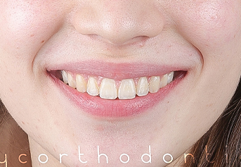 Smile with class 2 bite alignment issue before orthodontic treatment