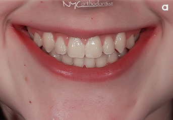 Smile with crowding before orthodontic treatment