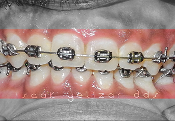 Gummy smile before reshaping