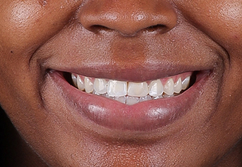 Smile after treatment for impacted teeth