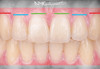 Smile showing laser gum reshaping plan