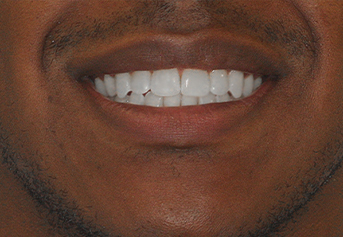 Smile after treatment for open bite