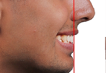 Smile with overbite before orthodontic treatment