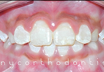 Child's smile before phase one orthodontic treatment
