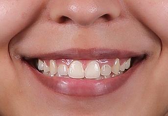 Smile after treatment for underbite