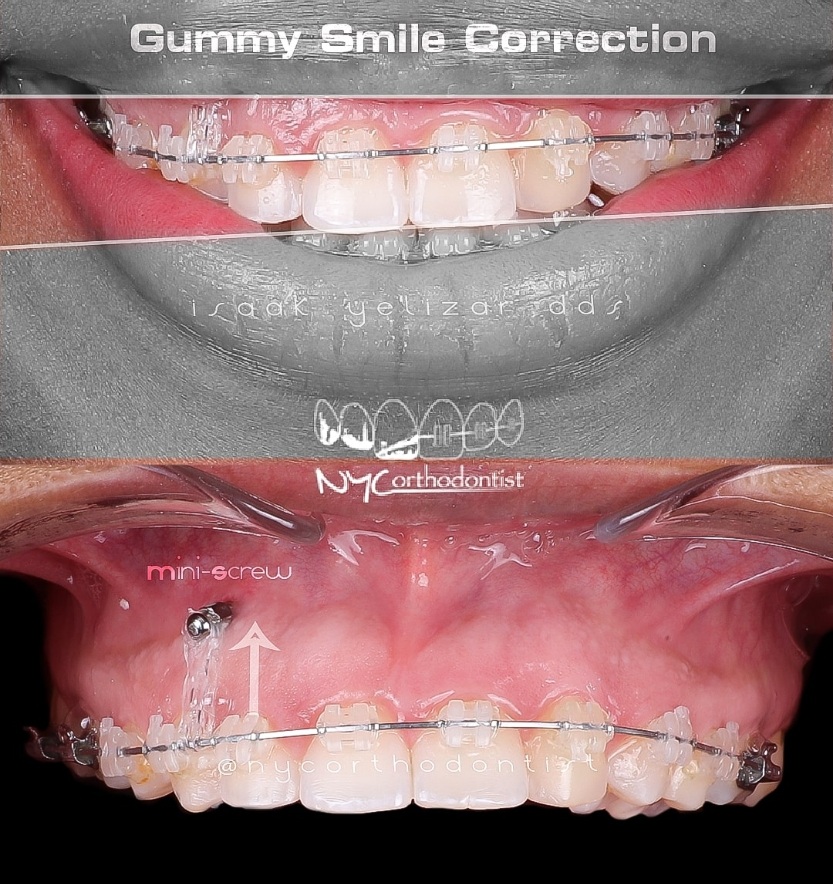 Smile before and after gummy smile correction