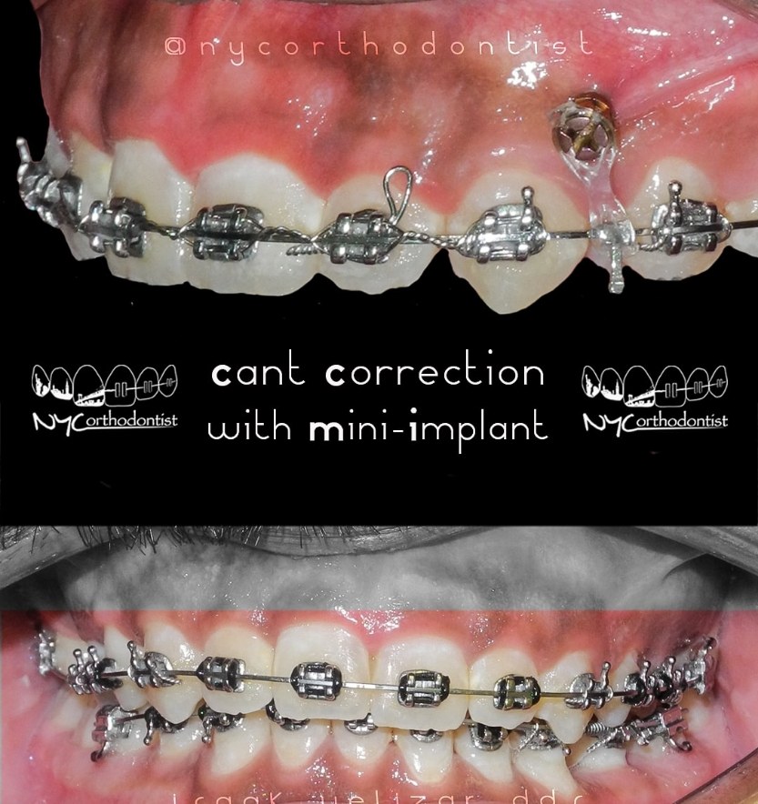 Comparing smile before and after gummy smile correction
