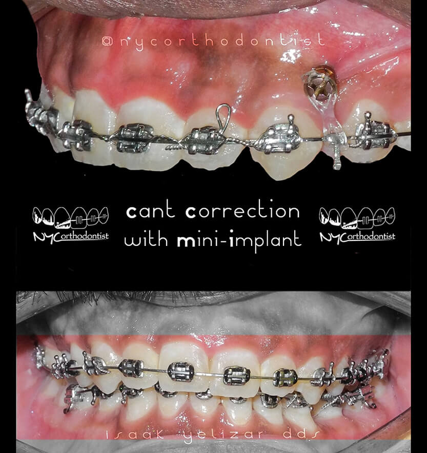 Comparing smile before and after gummy smile correction