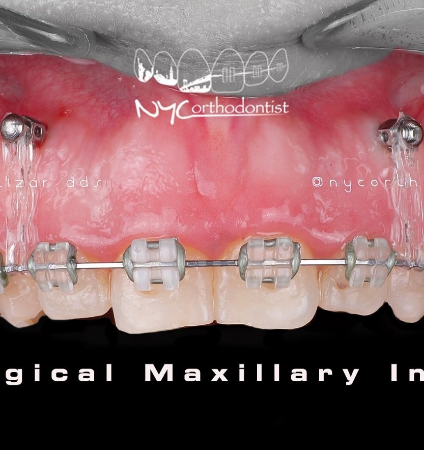 Closeup of smile before gummy smile correction