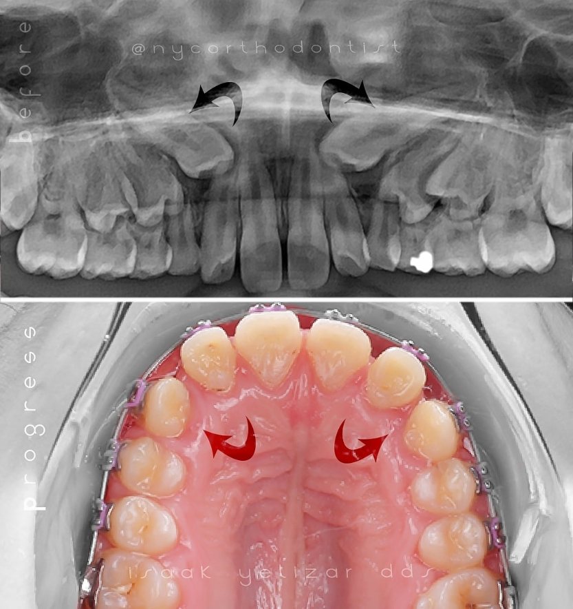 X-ray of smile and inside of teeth before and after treatment for impacted teeth