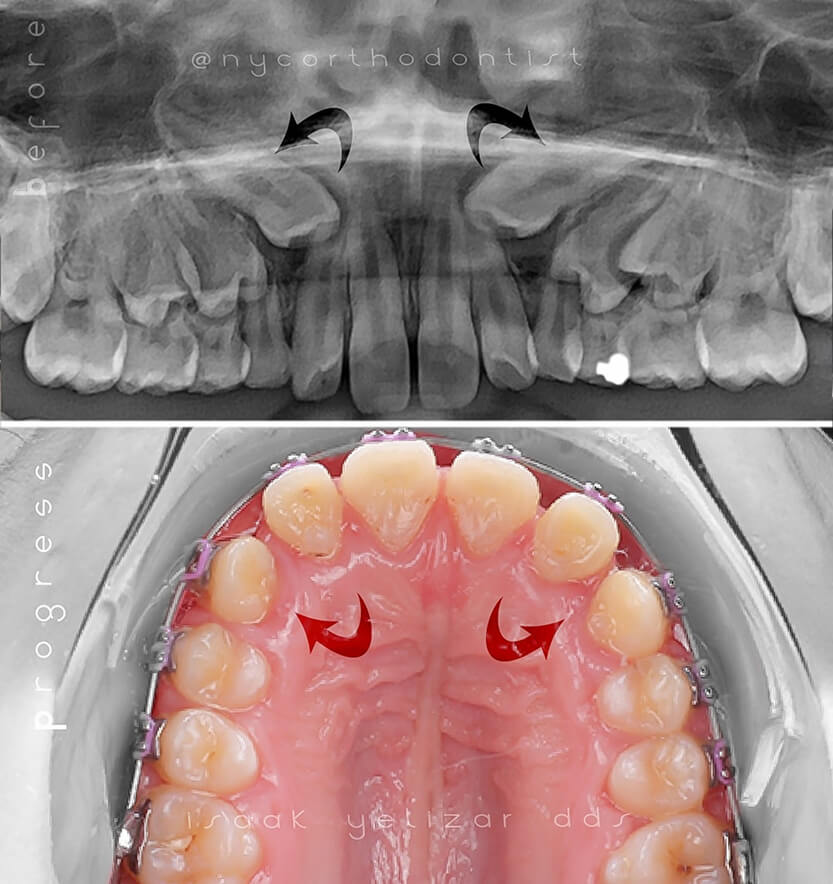 X-ray of smile and inside of teeth before and after treatment for impacted teeth