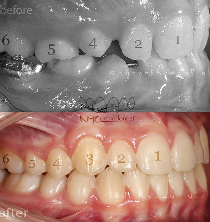 Side view of smile before and after treatment for impacted teth