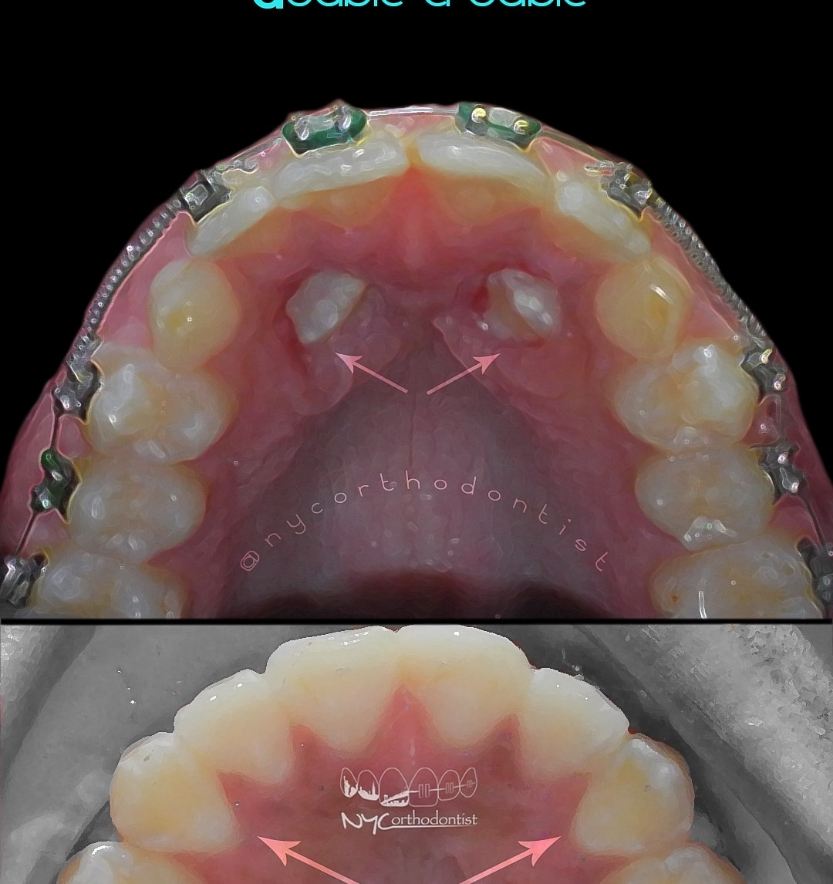Inside of teeth showing two impacted teeth before and flawless smile after impacted teeth treatment