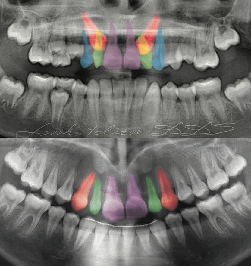 Color coded x-rays showing impacted teeth treatment before and after