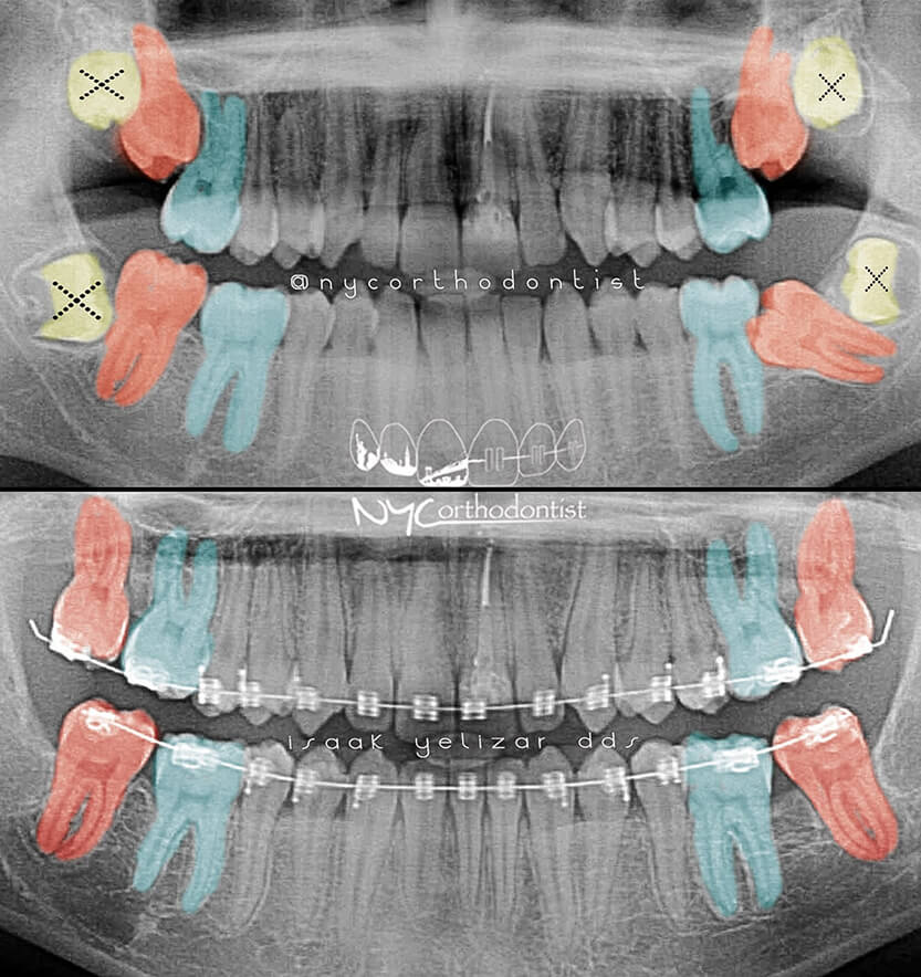 X-rays color coded to show impacted back teeth treatment