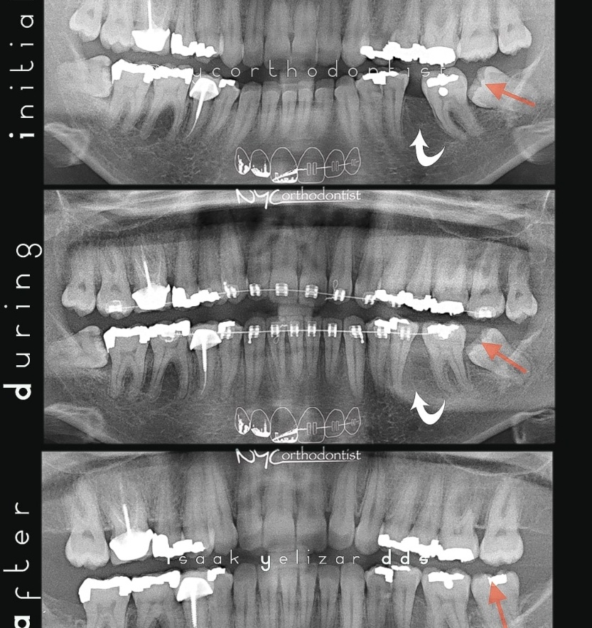 X-rays before during and after impacted teeth treatment