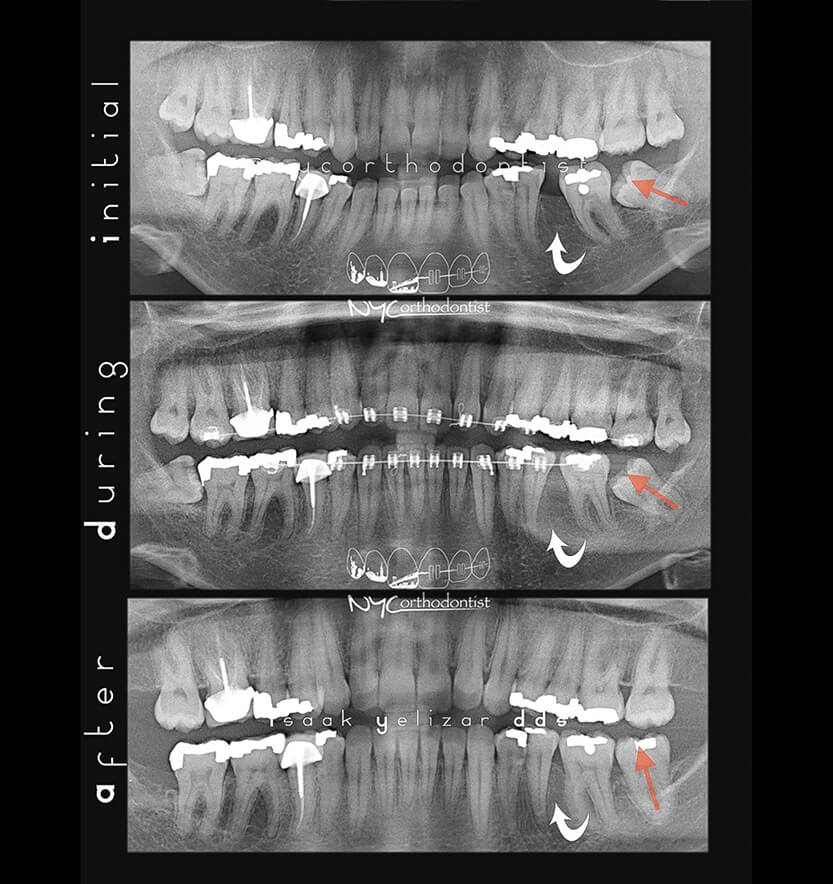 X-rays before during and after impacted teeth treatment