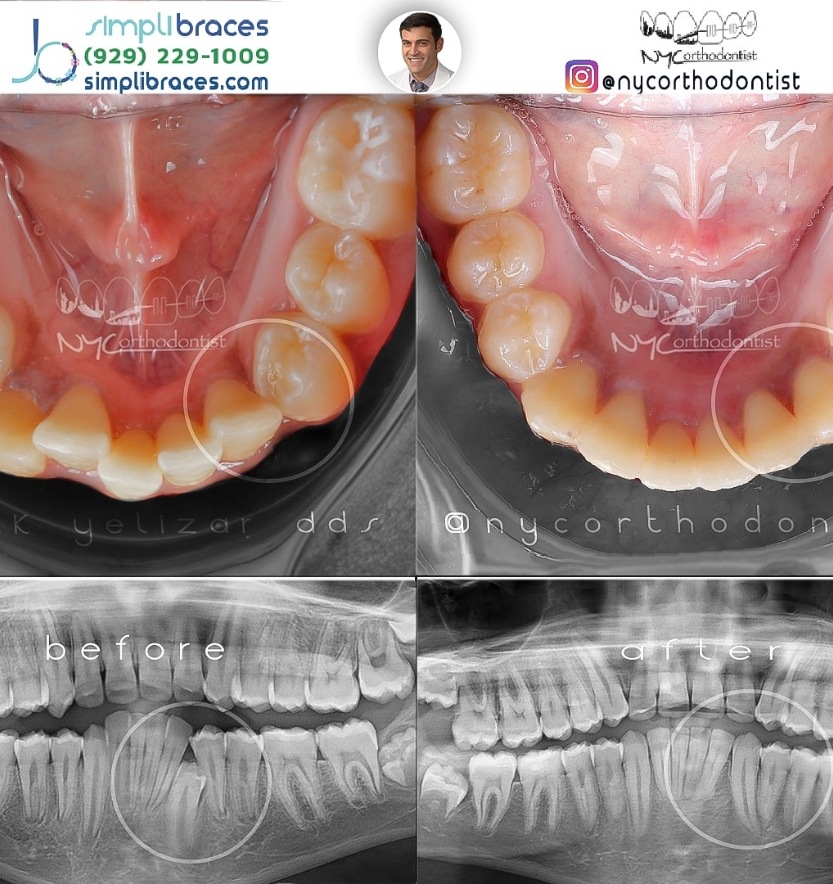 X-ray of profile and inside of bottom arch before and after impacted teeth treatment