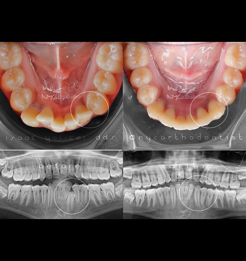 X-ray of profile and inside of bottom arch before and after impacted teeth treatment