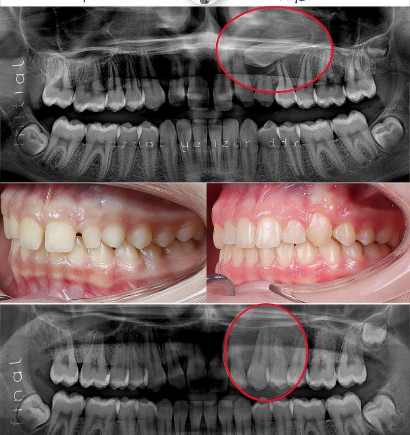 Side view and x-rays of smile before and after treatment for impacted teeth
