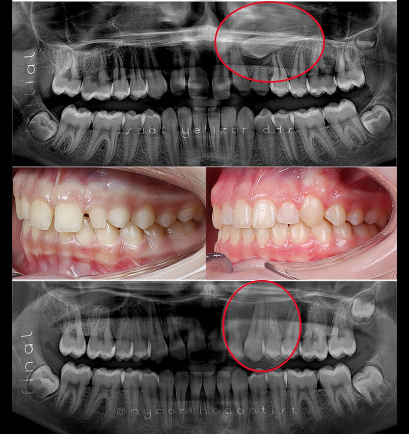 Side view and x-rays of smile before and after treatment for impacted teeth