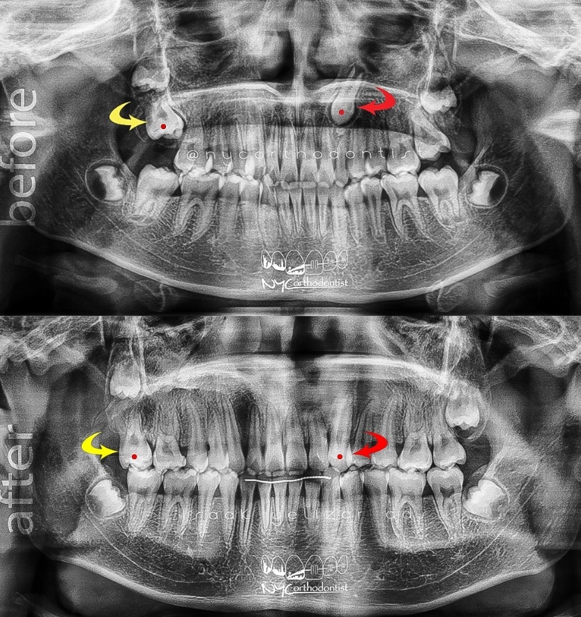 X-rays of smile before and after treatment for impacted teeth