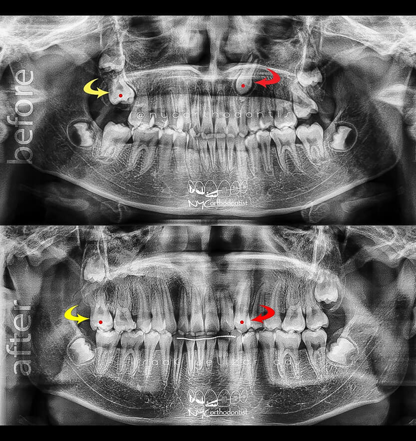 X-rays of smile before and after treatment for impacted teeth