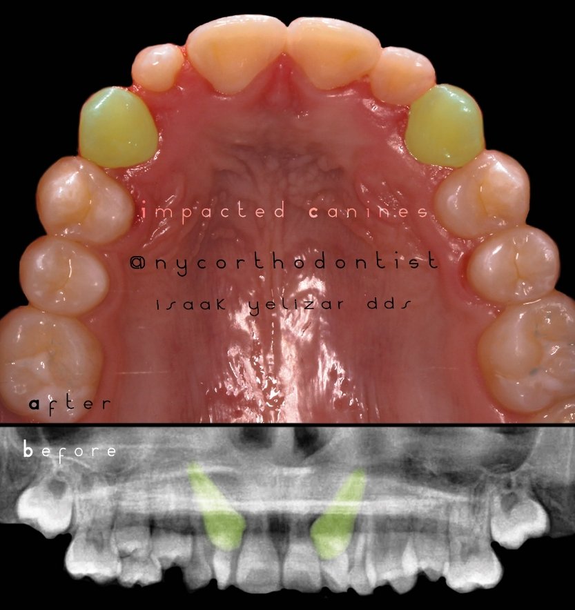 X-ray of smile before and inside of bottom teeth after treatment for impacted teeth