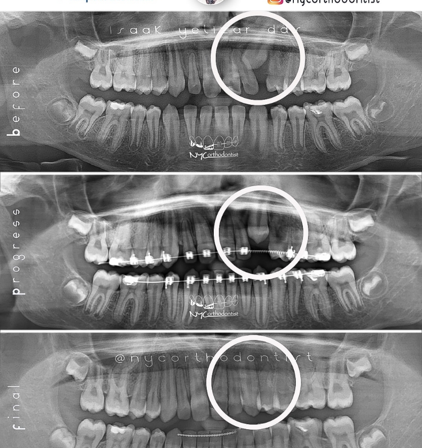 X-rays of smile before during and after treatment for impacted teeth