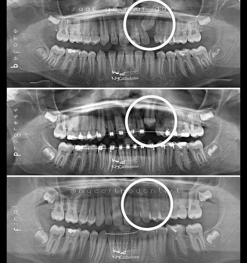 X-rays of smile before during and after treatment for impacted teeth