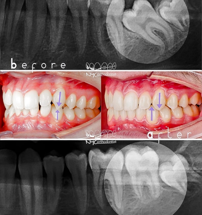 X-ray of teeth and side view of smile before and after treatment for impacted teeth
