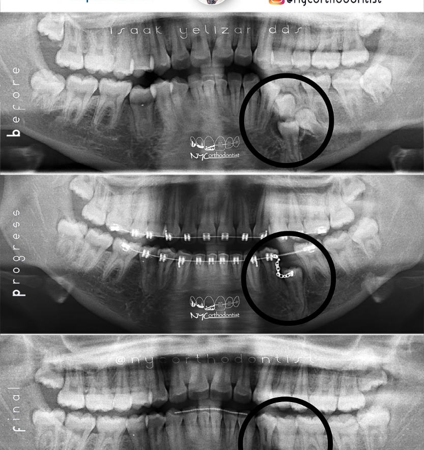 X-ray of smile before during and after impacted teeth treatment
