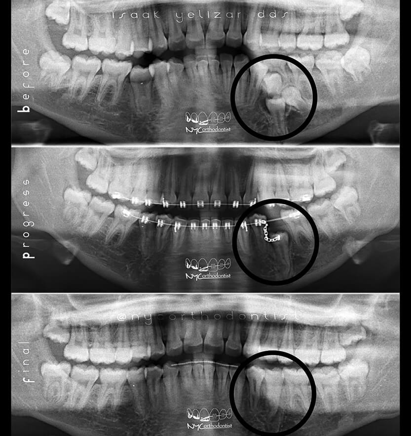 X-ray of smile before during and after impacted teeth treatment