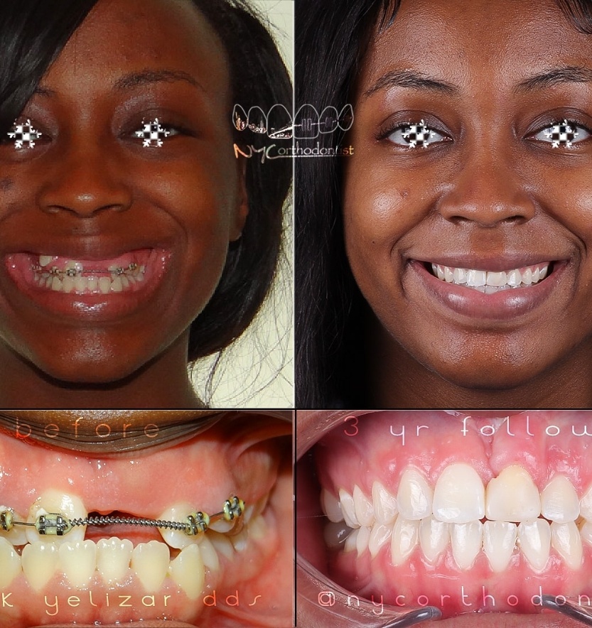 Front view of smle before and after treatment for impacted teeth