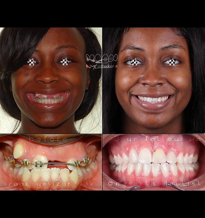 Front view of smle before and after treatment for impacted teeth
