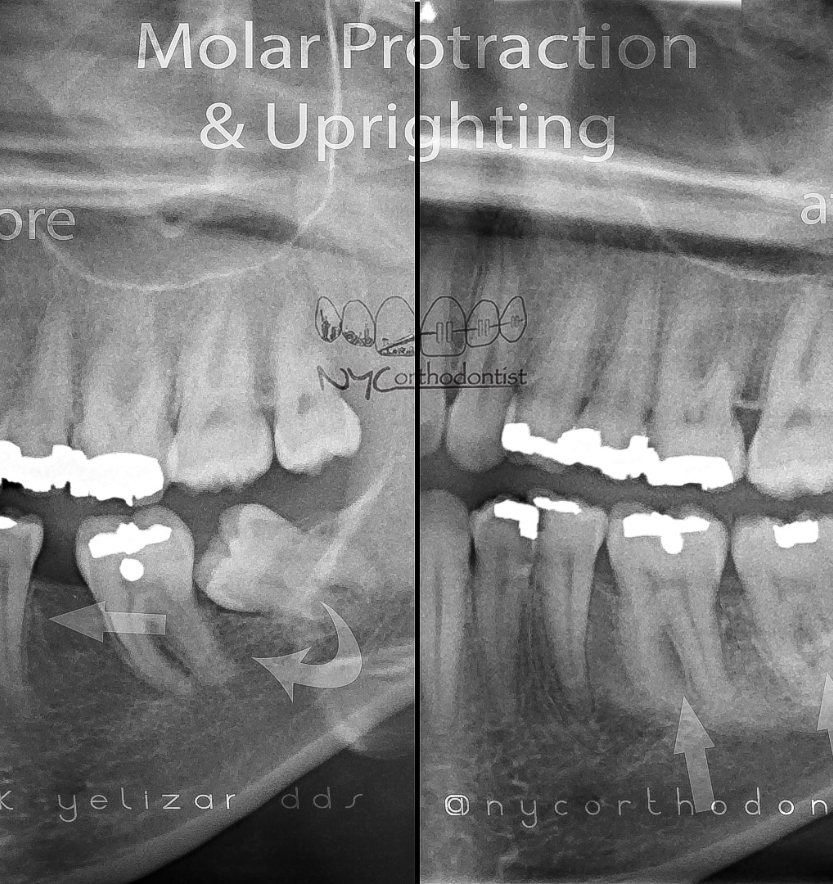 X-ray showing impacted molar and aligned smile after tooth is correctly positioned
