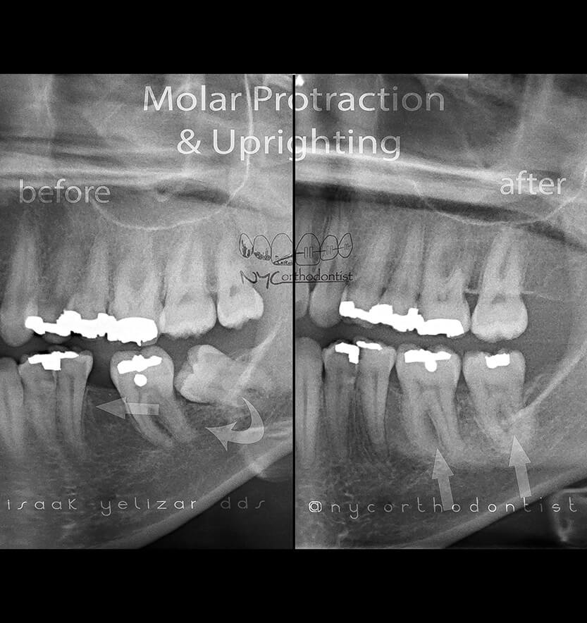 X-ray showing impacted molar and aligned smile after tooth is correctly positioned