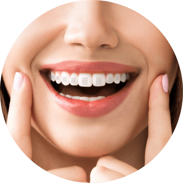 Smile with demonstration of clear and ceramic braces