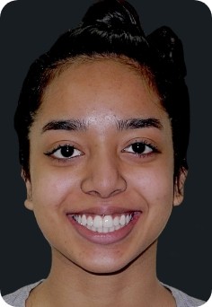 Young woman sharing healthy smile into orthodontic treatment