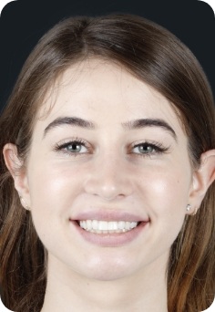 Young female orthodontic patient in Queens smiling
