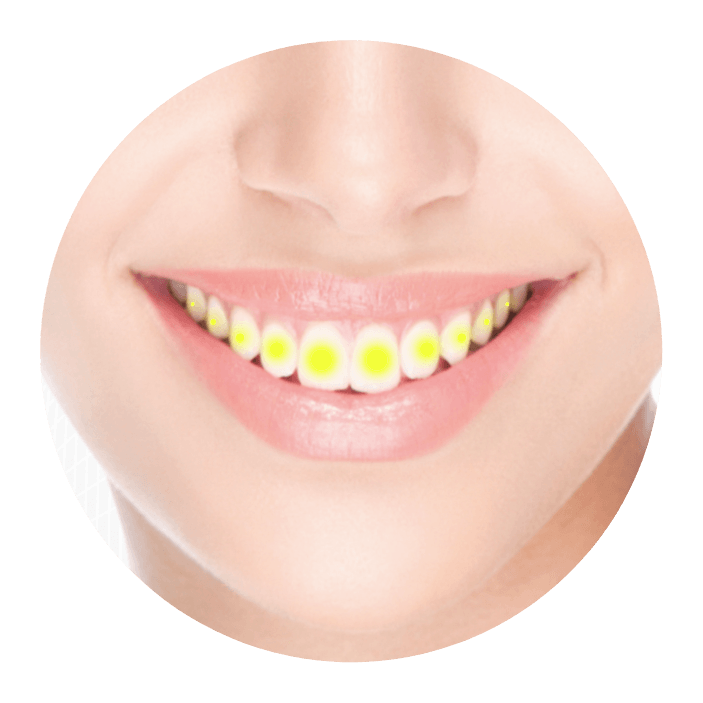 Close up of smile with yellow dots on each tooth