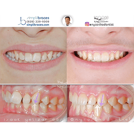 Smile before and after orthodontic treatment