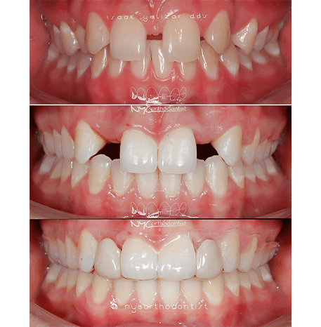 Smile before and after orthodontic treatment to close gaps in teeth