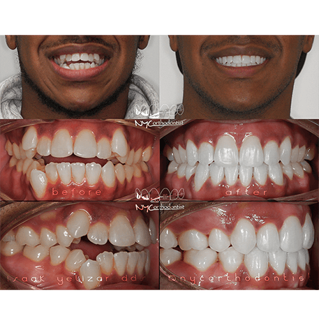Smile before and after orthodontic treatment for open bite and crooked teeth