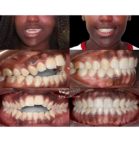 Smile before and after open bite correction